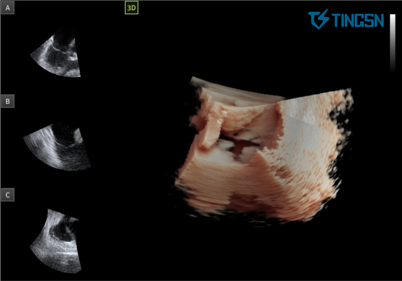 3 心室收缩期 三尖瓣瓣叶呈闭合状态.png
